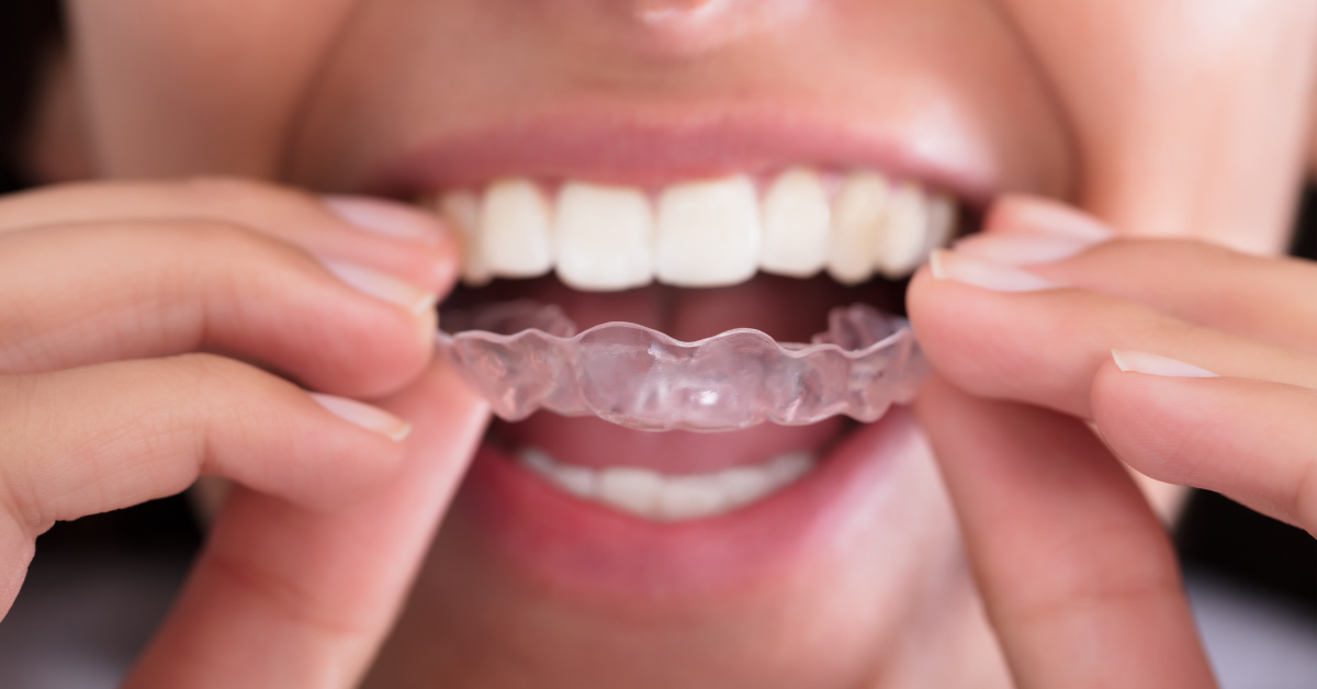 simply smile clear aligner